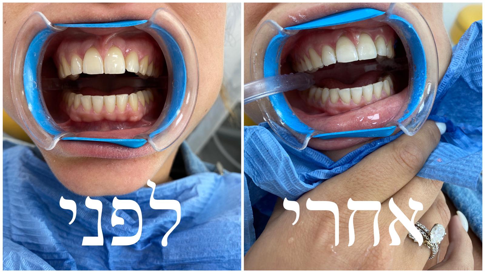 הלבנת שיניים - לפני ואחרי
