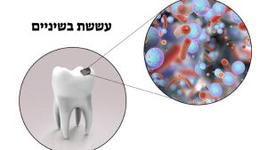 Read more about the article הטיפול לעששת בשיניים