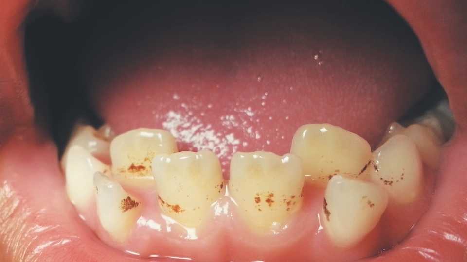 Read more about the article כתמים בשיניים – מניעה וטיפול
